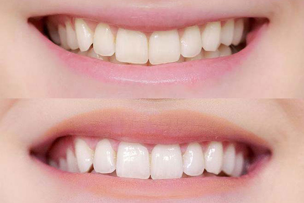albirea-dintilor-diferente-02