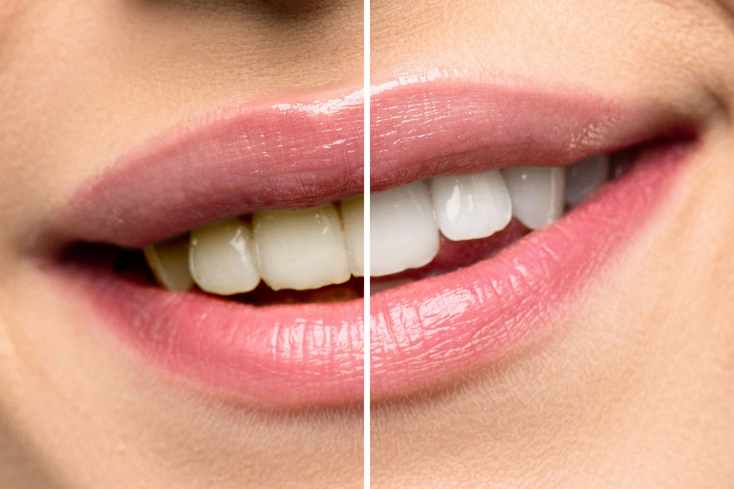 zambet-stralucitor-inainte-dupa--shine-albire-dinti-02